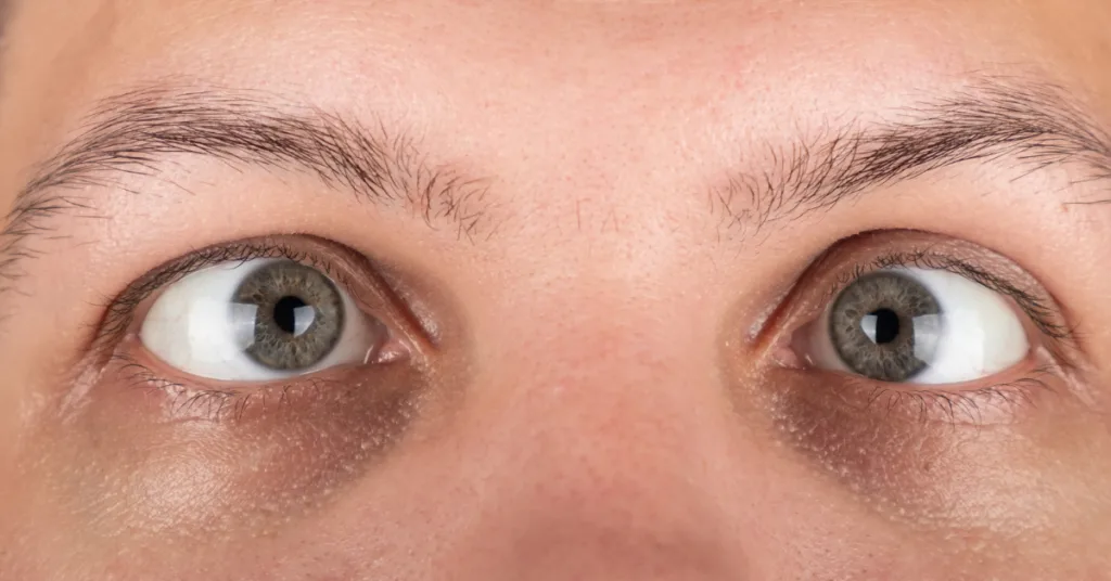 How Botox Works for Strabismus
