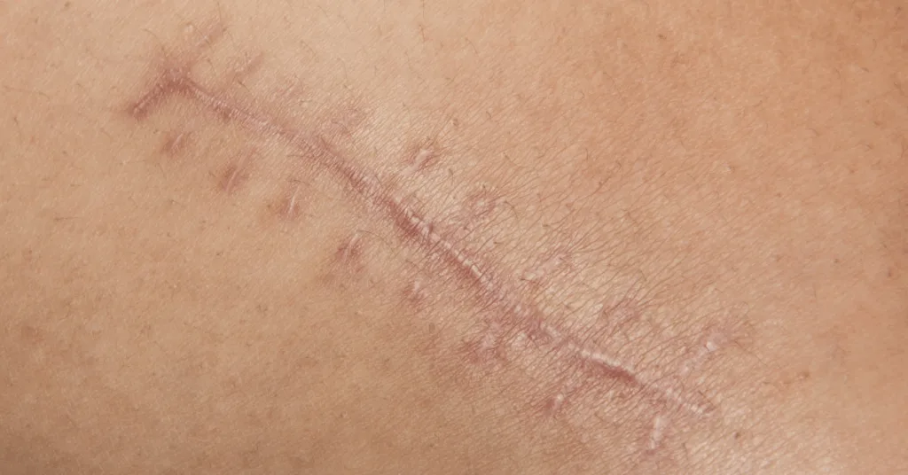 Scar Management: Modern Approaches and Techniques