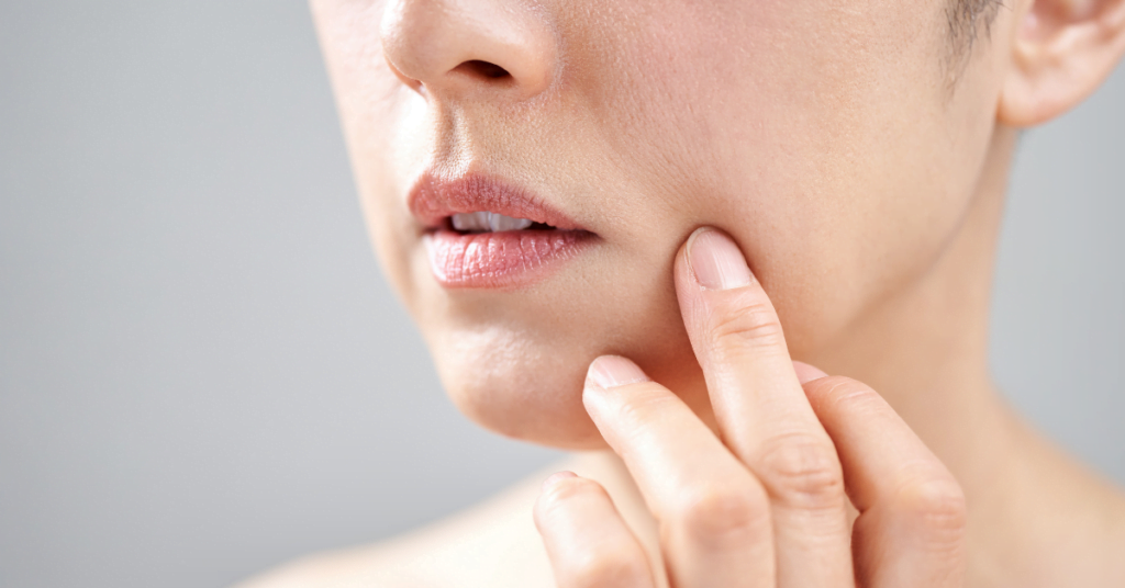 Botox for Nasolabial Folds: Smoothing Laugh Lines